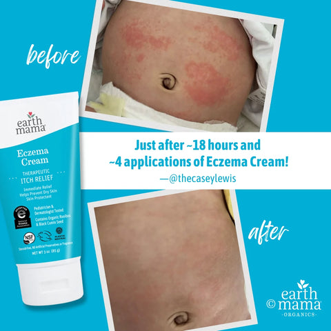 Eczema Cream